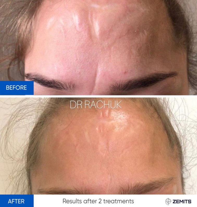 Zemits CarbonFrax Pro: CO2 Fractionele Laser