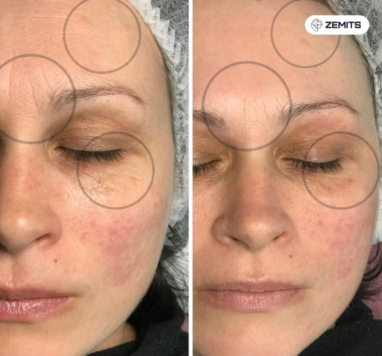Zemits Klein RF Huidverstrakkingssysteem