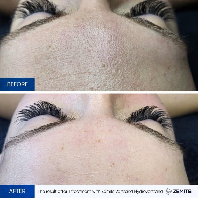 Zemits HydroVerstand PRO 7-in-1 HydroDiamond™ Systeem