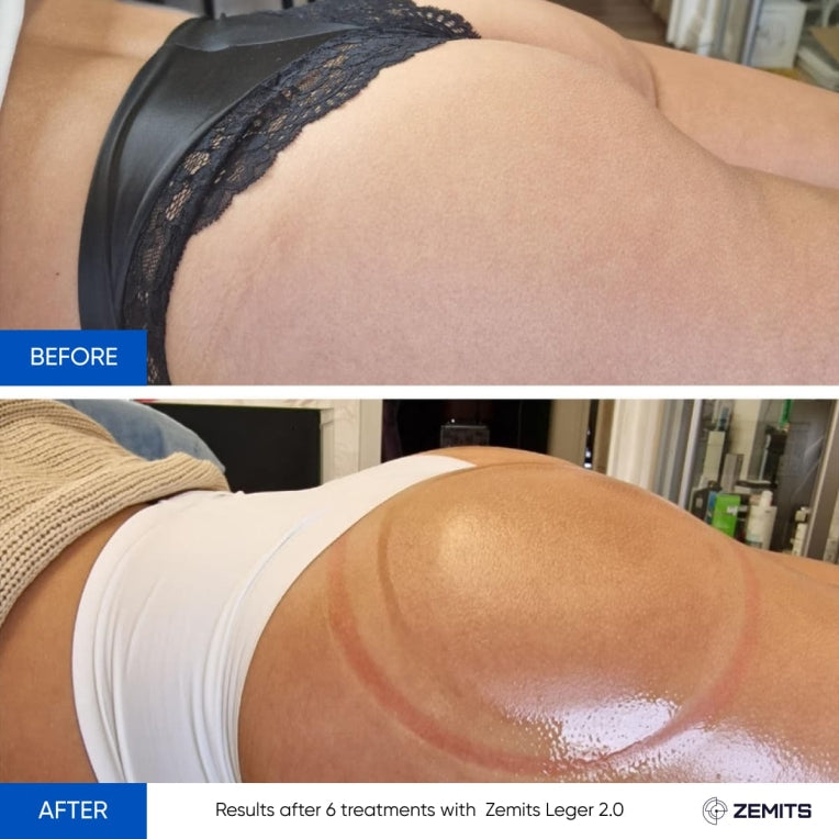 Zemits Leger 2.0 Vacuüm Cupping Systeem met XXL Cups in Set