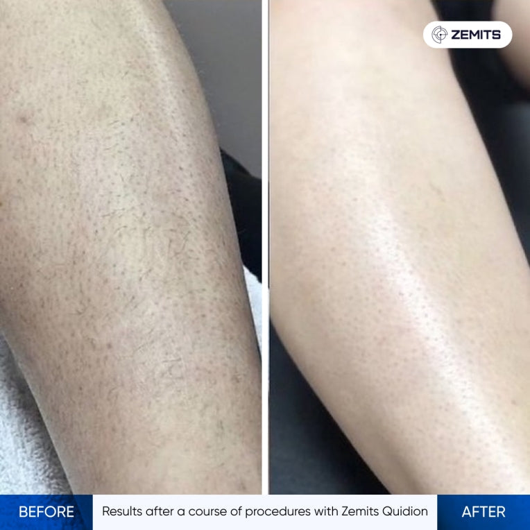 Zemits Quidion Diodelaser voor ontharing
