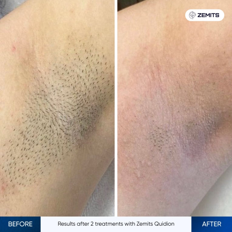 Zemits Quidion Diodelaser voor ontharing
