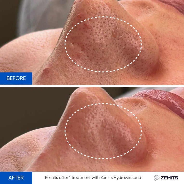 Zemits HydroVerstand PRO 7-in-1 HydroDiamond™ Systeem