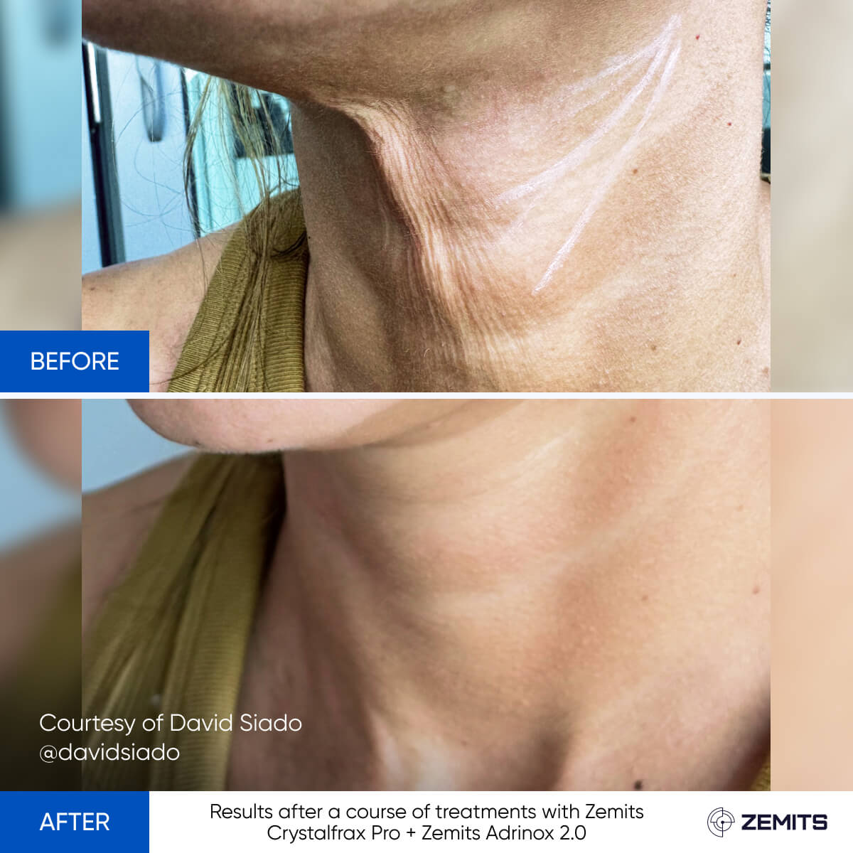 Before After Slide 4